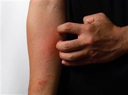 Nuevos tratamientos avanzados ofrecen alivio para el eczema grave