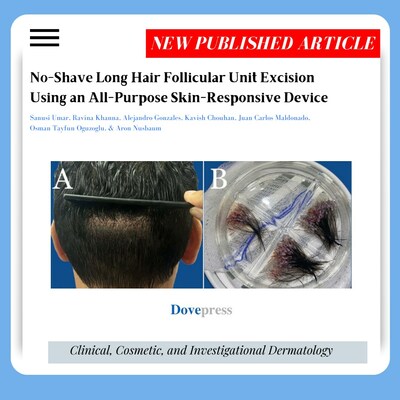 El área de donación se muestra rápidamente después de un procedimiento FUE de cabello largo con UGraft Zeus (A). Injertos de cabello largo de una persona de cabello lacio (B).